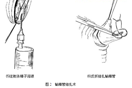 结扎输精管